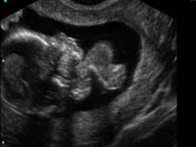 בדיקה חדשה לתסמונת דאון בשבוע 10 להריון
